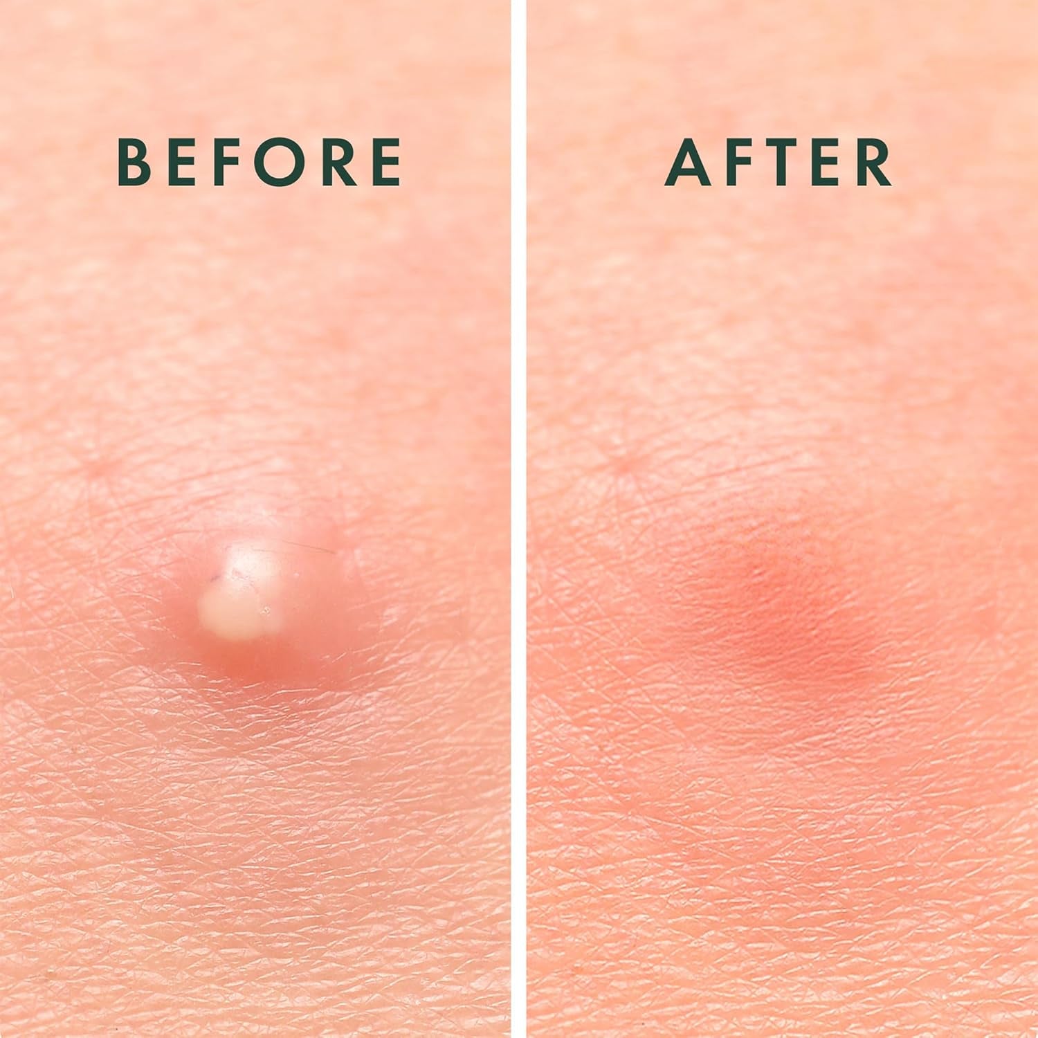 Pimple Patches, Miracle Invisible Spot Cover - Hydrocolloid Acne Patch, Treatment for Breakouts, Absorbs Zits & Blemish, Korean Skin Care, 2 Sizes (96 Count)