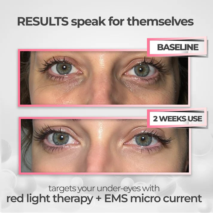 RevitalEyes Red Light + EMS Under-Eye Therapy