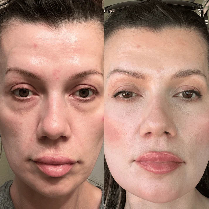 RevitalEyes Red Light + EMS Under-Eye Therapy
