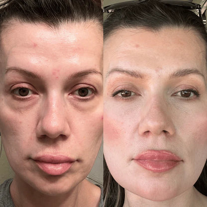 RevitalEyes Red Light + EMS Under-Eye Therapy