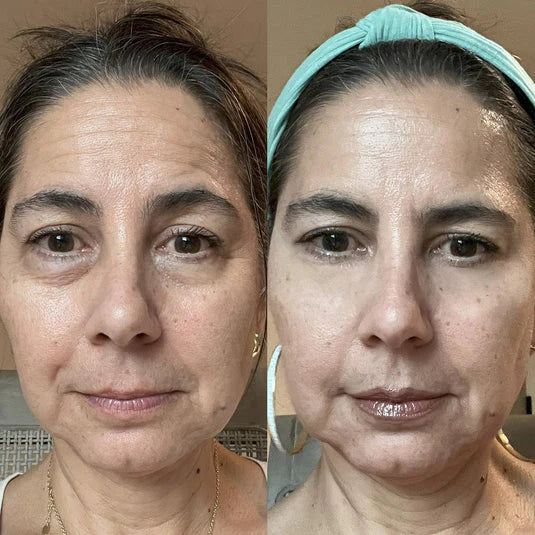 RevitalEyes Red Light + EMS Under-Eye Therapy